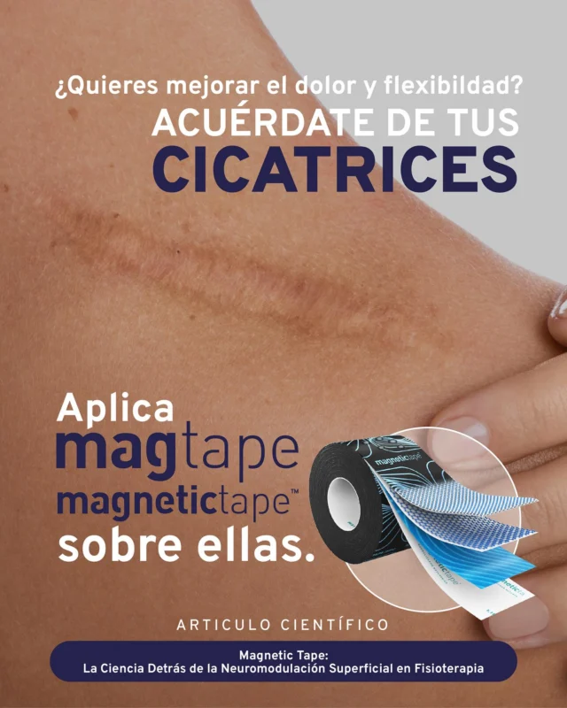 🧲 ¿Quieres mejorar el dolor y la flexibilidad?
¡ACUÉRDATE DE TUS CICATRICES!
⠀
Las cicatrices pueden alterar el equilibrio neuromuscular.
⠀
✨ Aplica Magnetic Tape directamente sobre ellas y siente la diferencia.
⠀
🔬 Respaldo científico disponible:
📄 “Magnetic Tape: La ciencia detrás de la neuromodulación superficial en fisioterapia.”  https://mag-tape.com/magnetic-tape-la-ciencia-detras-de-la-neuromodulacion-superficial-en-fisioterapia/